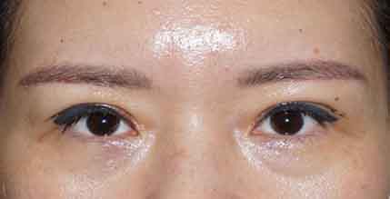 Blepharoplastic Surgery Dr Looi post operatively Day 12 429x219