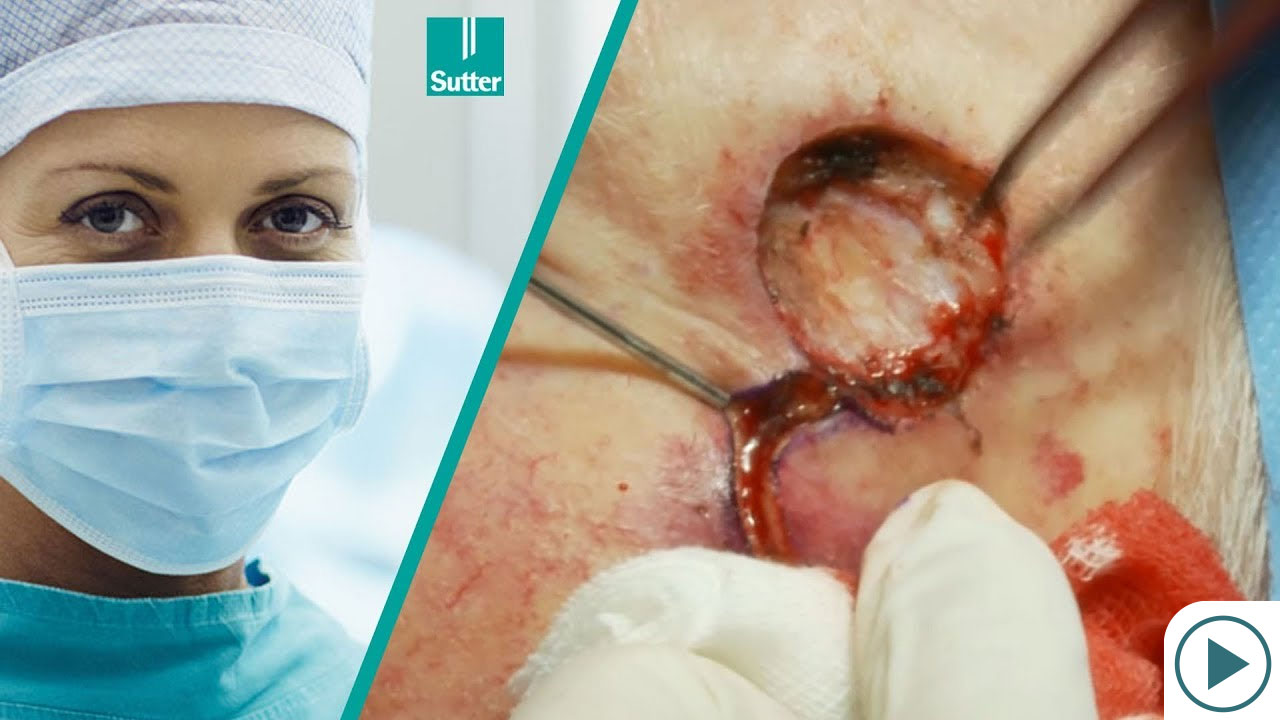 Removal of Skin Tumor Using Radiofrequency