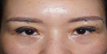 Blepharoplastic Surgery Dr Looi post operatively Day 1
