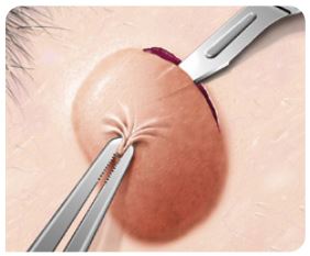 Tangential-excision-of-papular-nevus