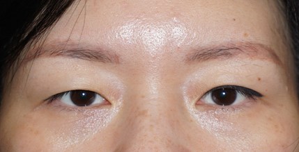 Blepharoplastic Surgery Dr Looi Pre operatively