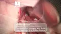 Neurosurgical procedure showing extensive tumor shrinking using SuperGliss® non-stick ELP Bipolar Forceps, Department of Neurosurgery, University Medical Center Freiburg, Germany