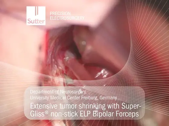 extensive-tumor-shrinking-supergliss-elp-bipolar-forceps-ukf-freiburg.jpg Neurosurgical procedure showing extensive tumor shrinking using SuperGliss® non-stick ELP Bipolar Forceps, Department of Neurosurgery, University Medical Center Freiburg, Germany