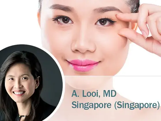 Porträt einer jungen Frau, die auf ihre Augenlider zeigt, kombiniert mit einem Bild von Dr. A. Looi aus Singapur; Hinweis auf ästhetische Lidchirurgie mit Radiofrequenz.