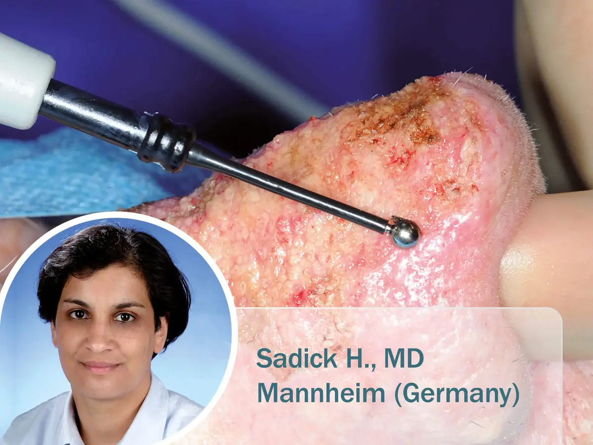 Medizinische Nahaufnahme eines Rhinophyms während einer Behandlung mit einer Kugel-Elektrode; im Bild eingeblendet: Dr. Sudeshna A., Fachärztin für plastische und ästhetische Chirurgie.