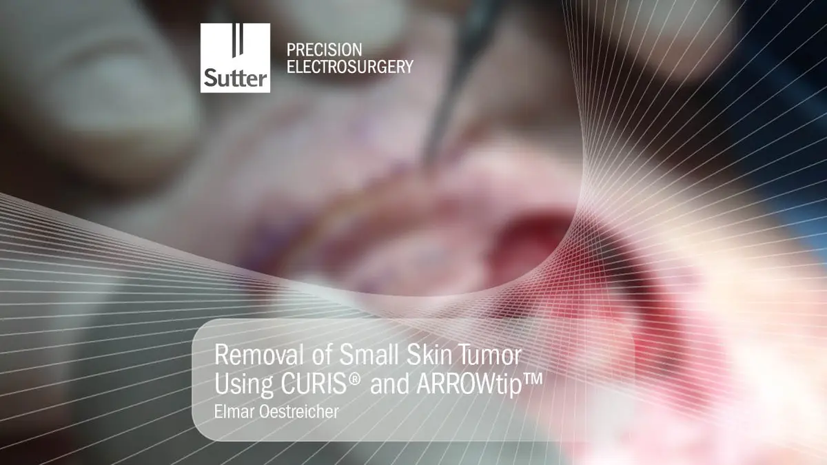 blurred-removal-small-skin-tumor-curis-arrowtip-elmar-oestreicher.jpg Blurred Removal of small skin tumor using CURIS® radiofrequency generator and ARROWtip™, surgical procedure by Dr. Elmar Oestreicher