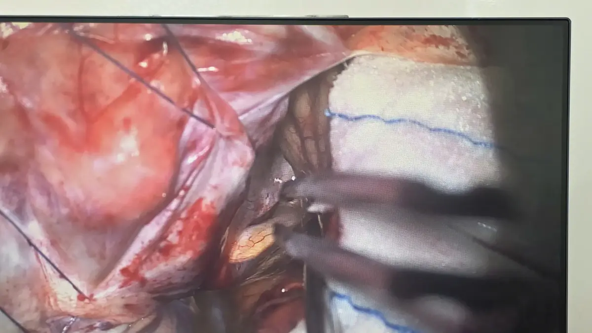 SuperGliss® beim Einsatz in der Neurochirurgie SuperGliss® non‑stick bipolare Pinzette von Sutter Medizintechnik im Einsatz bei einer komplexen neurochirurgischen Operation in Vietnam