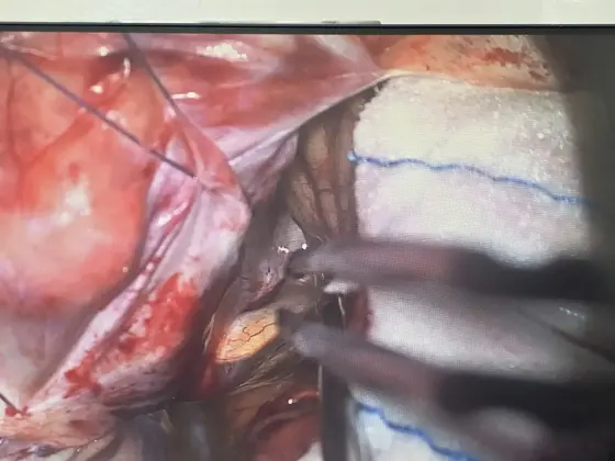 SuperGliss® non‑stick bipolare Pinzette von Sutter Medizintechnik im Einsatz bei einer komplexen neurochirurgischen Operation in Vietnam