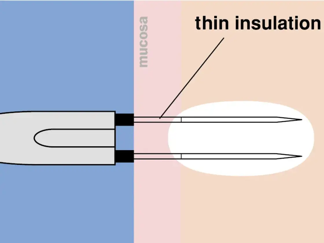 Grafische Darstellung der korrekt platzierten RaVoR™ bipolaren Elektrode an Nasenmuschel und Weichgaumen. Das vollständige Einführen der dünnen Isolation schützt die Schleimhaut vor Oberflächenläsionen.