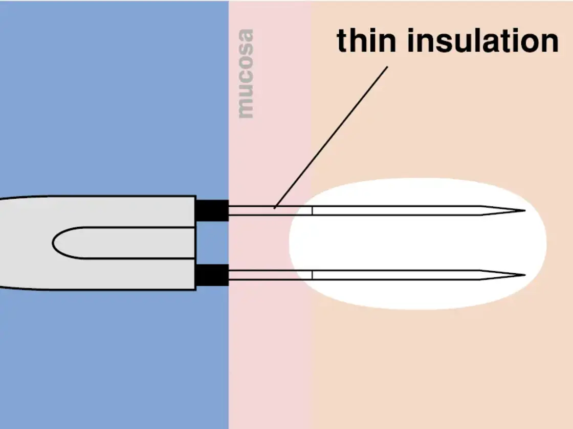 Grafische Darstellung der korrekt platzierten RaVoR™ bipolaren Elektrode an Nasenmuschel und Weichgaumen. Das vollständige Einführen der dünnen Isolation schützt die Schleimhaut vor Oberflächenläsionen.