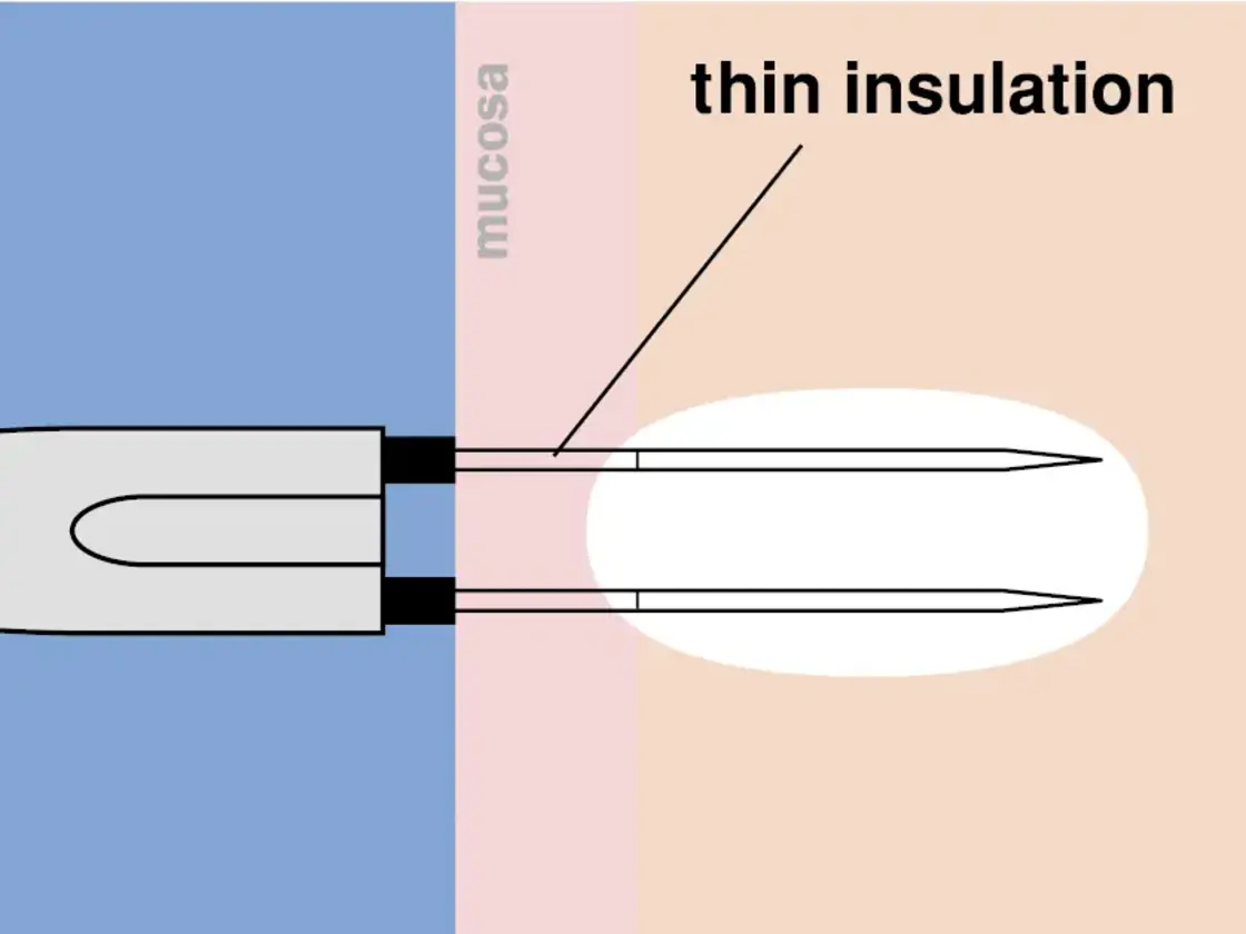 Grafische Darstellung der korrekt platzierten RaVoR™ bipolaren Elektrode an Nasenmuschel und Weichgaumen. Das vollständige Einführen der dünnen Isolation schützt die Schleimhaut vor Oberflächenläsionen.