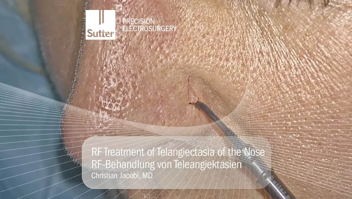 Radiofrequenzbehandlung von Teleangiektasien an der Nase mit Präzisionselektrochirurgie, durchgeführt von Dr. Christian Jacobi