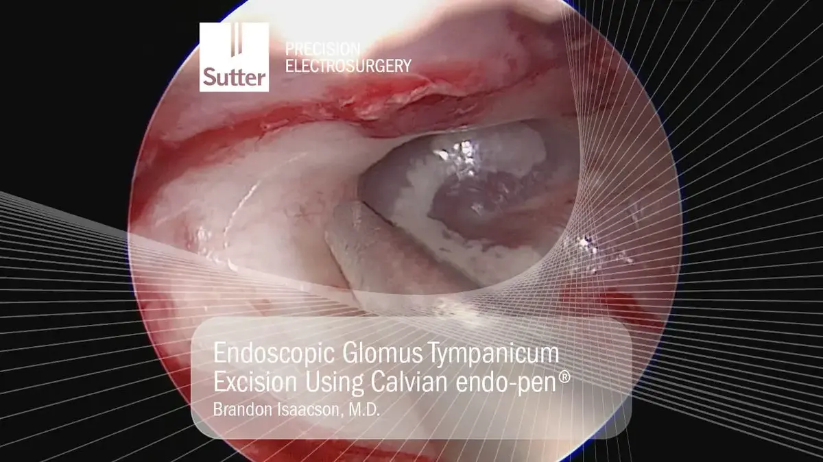 Endoscopic view of glomus tympanicum excision using Calvian endo-pen® by Brandon Isaacson, M.D.