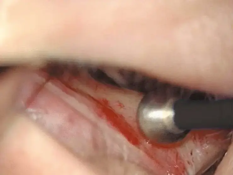 Nahaufnahme einer monopolaren Elektrode bei einem chirurgischen Eingriff