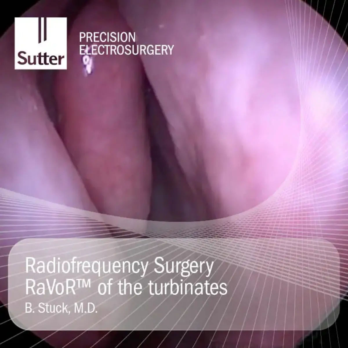 Endoskopisches Bild einer Radiofrequenz-Anwendung an den Nasenmuscheln