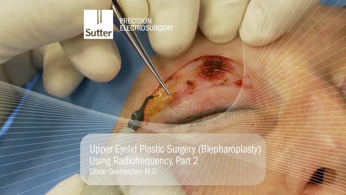 Close-up of upper eyelid plastic surgery (blepharoplasty) using radiofrequency, part 2, performed by Elmar Oestreicher, M.D., showing surgical procedure details.