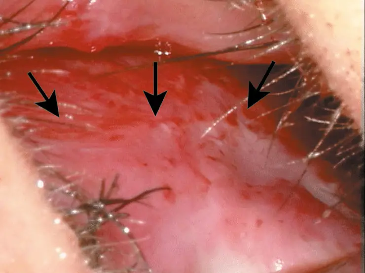 Nahaufnahme von Gewebe mit drei schwarzen Pfeilen zur Markierung bestimmter Strukturen.