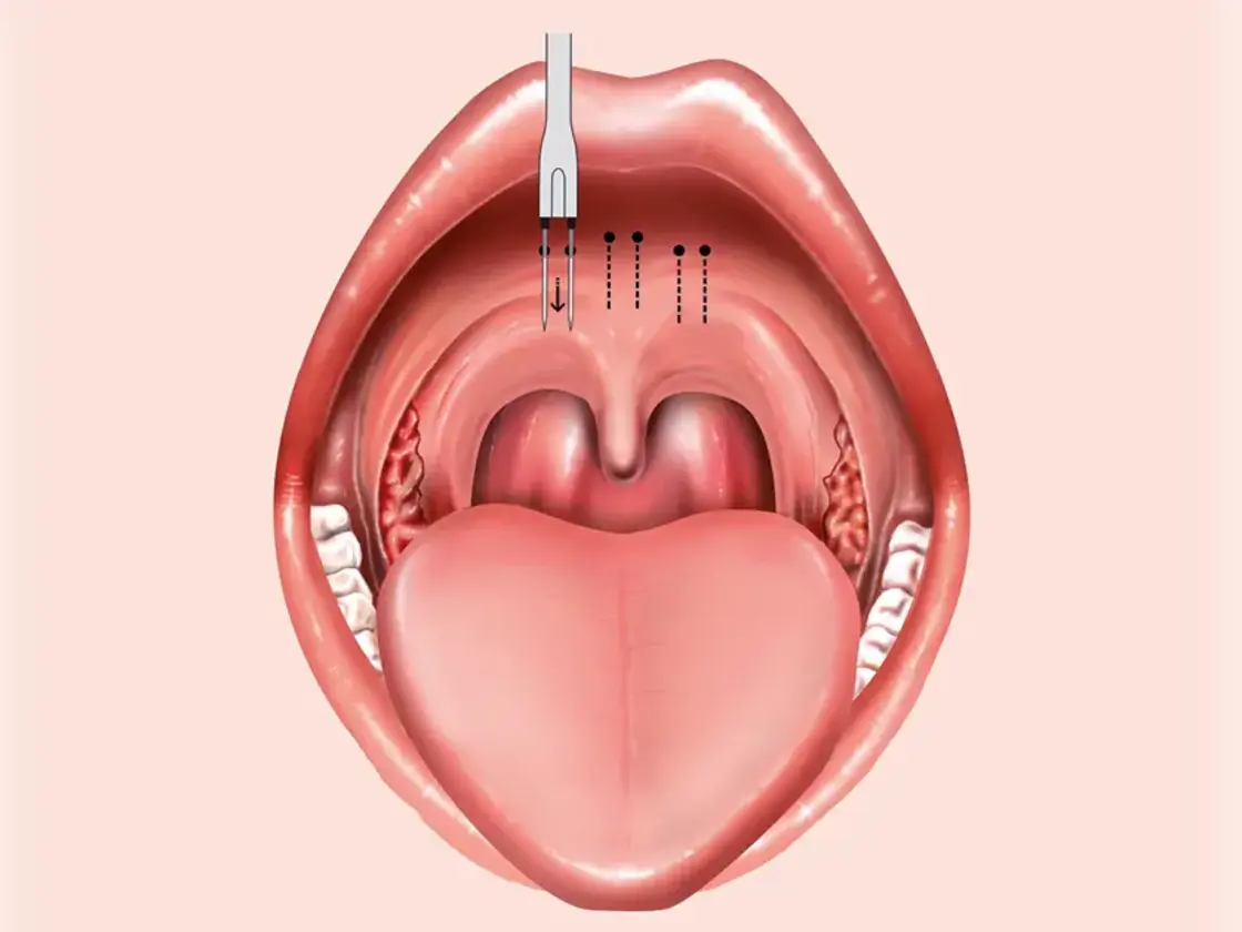 Grafische Darstellung der Einstichstellen für die Applikation der Radiofrequenzenergie am Zungengrund