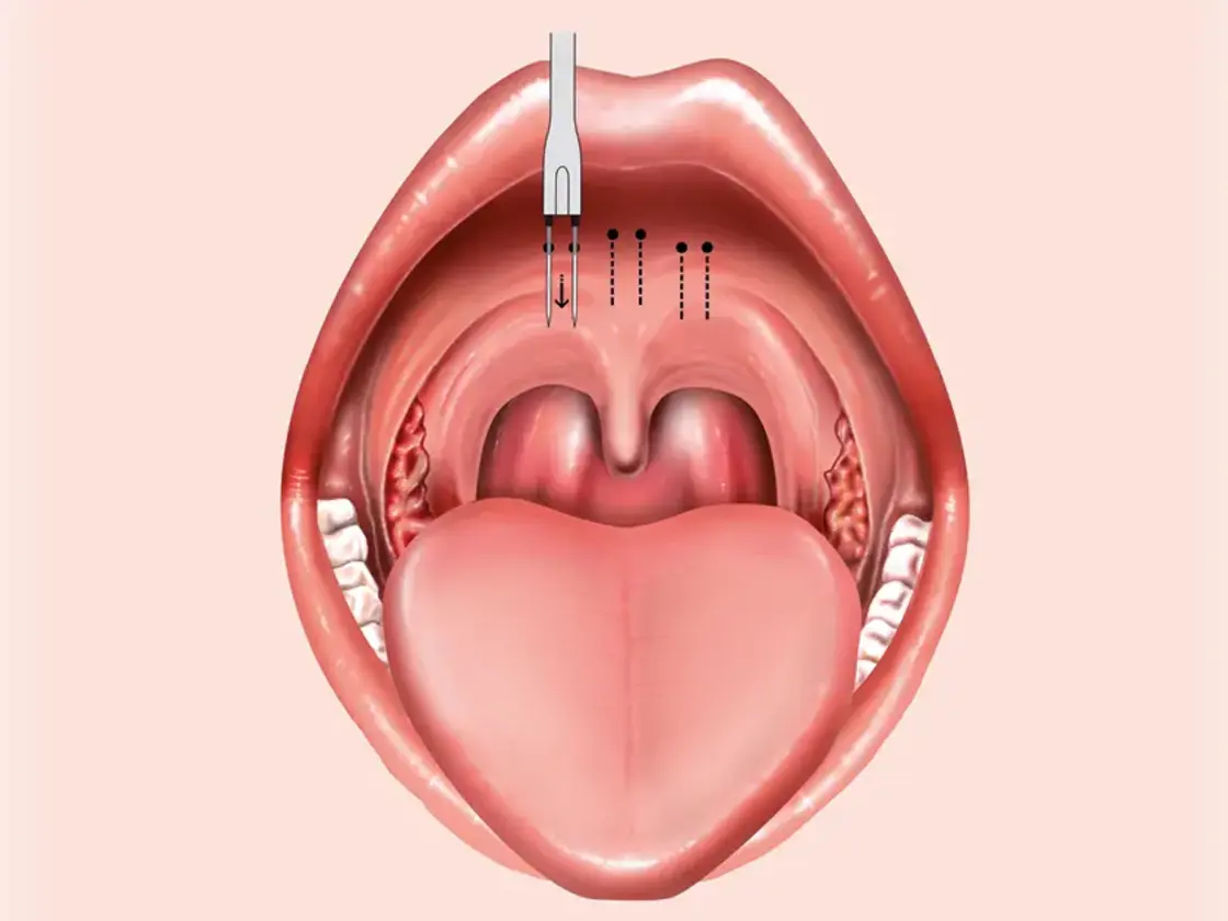 Grafische Darstellung der Einstichstellen für die Applikation der Radiofrequenzenergie am Zungengrund