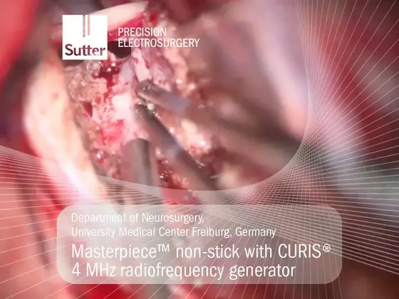 masterpiece-non-stick-curis-4mhz-radiofrequency-generator-ukf-freiburg.jpg Neurosurgical procedure using Masterpiece™ non-stick bipolar forceps with CURIS® 4 MHz radiofrequency generator at University Medical Center Freiburg, Germany