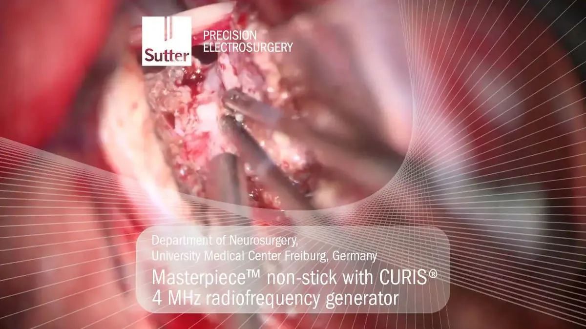 masterpiece-non-stick-curis-4mhz-radiofrequency-generator-ukf-freiburg.jpg Neurosurgical procedure using Masterpiece™ non-stick bipolar forceps with CURIS® 4 MHz radiofrequency generator at University Medical Center Freiburg, Germany