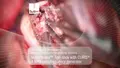 Neurosurgical procedure using Masterpiece™ non-stick bipolar forceps with CURIS® 4 MHz radiofrequency generator at University Medical Center Freiburg, Germany