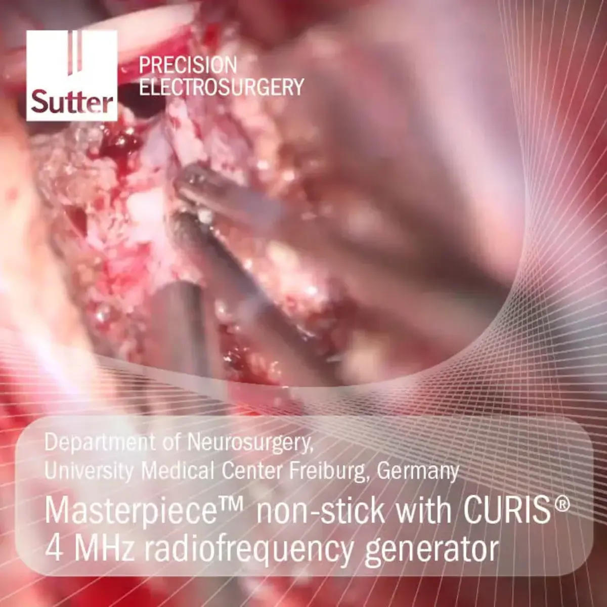 masterpiece-non-stick-curis-4mhz-radiofrequency-generator-ukf-freiburg.jpg Neurosurgical procedure using Masterpiece™ non-stick bipolar forceps with CURIS® 4 MHz radiofrequency generator at University Medical Center Freiburg, Germany