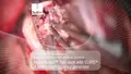 Neurosurgical procedure using Masterpiece™ non-stick bipolar forceps with CURIS® 4 MHz radiofrequency generator at University Medical Center Freiburg, Germany
