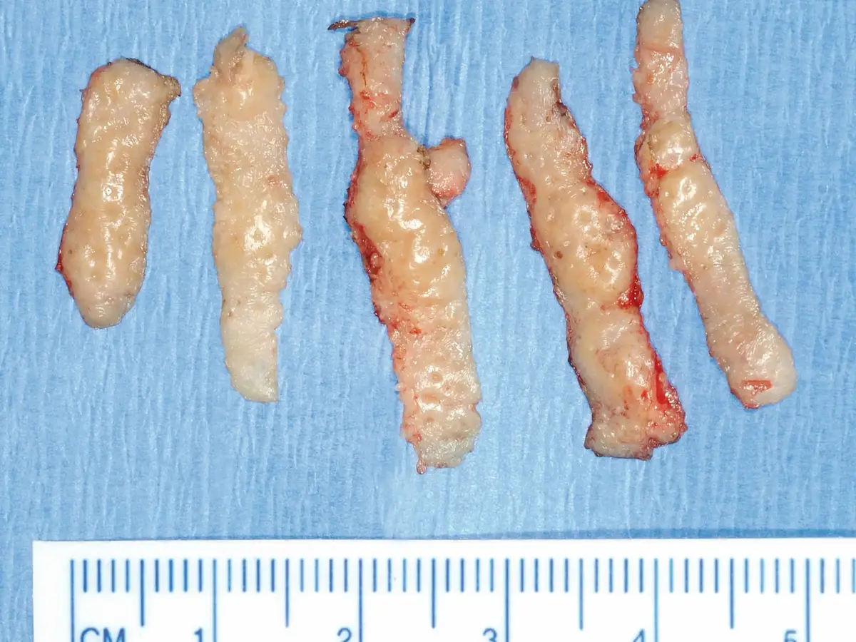 Five excised tissue strips on a blue surgical drape with centimeter scale.