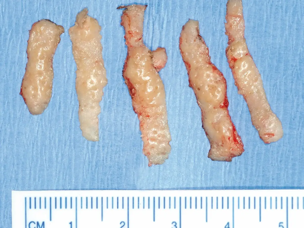 Fünf entfernte Gewebestreifen auf blauem OP-Tuch mit Zentimeterskala.