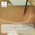 Application of radiofrequency and monopolar loop electrode for tangential ablation on skin, Sutter Precision Electrosurgery