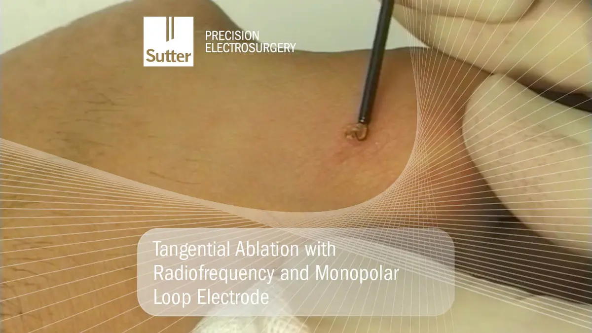 Application of radiofrequency and monopolar loop electrode for tangential ablation on skin, Sutter Precision Electrosurgery