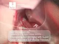 Intraoperatives Bild einer neurochirurgischen Tumorverkleinerung mit bipolarer SuperGliss® non-stick ELP Pinzette; sichtbare Gefäß- und Tumorstrukturen im Operationsfeld.