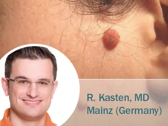 Nahaufnahme eines pigmentierten Muttermals (Naevus) an der Wange eines Patienten nahe dem Ohr; eingeblendet ein Portrait von Dr. Kasten mit dem Hinweis „Mainz | Germany“.