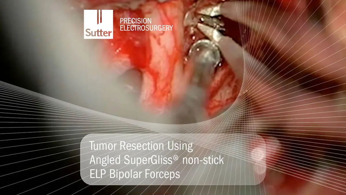 tumor-resection-angled-supergliss-nonstick-elp-bipolar-forceps.jpg Surgical scene showing tumor resection using angled SuperGliss® non-stick ELP bipolar forceps for precise electrosurgical procedures.
