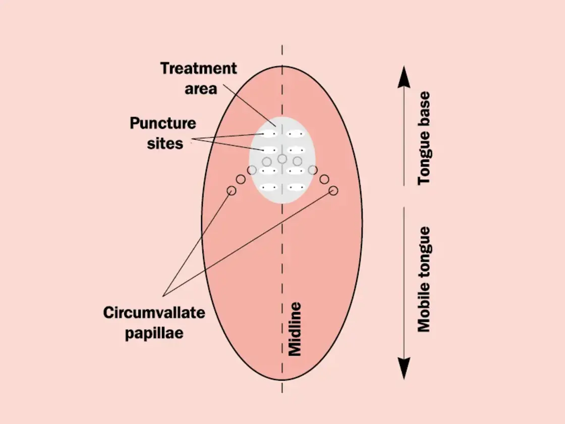 Grafische Darstellung der Einstichstellen für die Applikation der Radiofrequenzenergie am Zungengrund. mit Beschriftungen