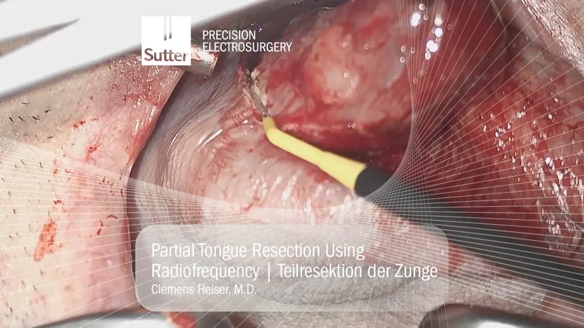 Operative Anwendung der ARROWtip™-Elektrode bei einer partiellen Zungenresektion; präzise Gewebeentfernung mit minimaler thermischer Ausbreitung.