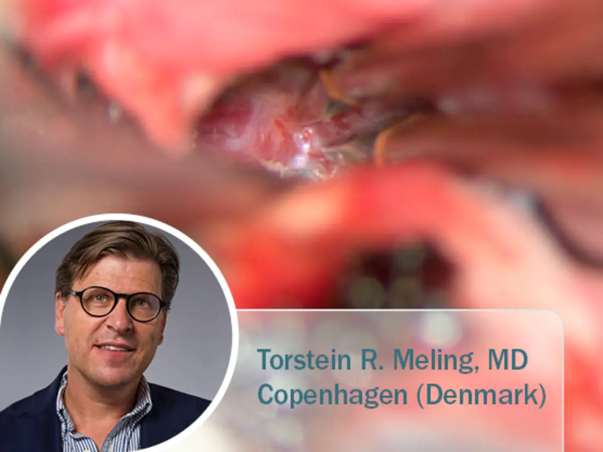 Chirurgische Nahaufnahme einer Oberlidkorrektur mit Radiofrequenz-Technologie; eingeblendet ist Dr. Thomas Mahler, Facharzt für Dermatologie aus Deutschland.
