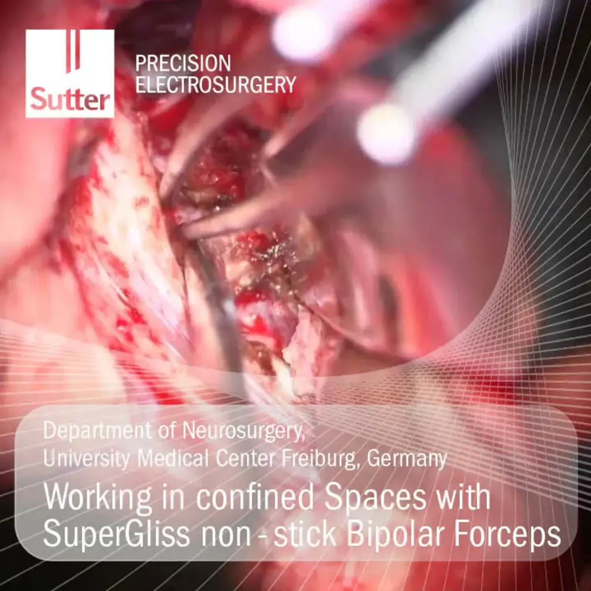 Surgical resection and reconstruction of a basal cell carcinoma near the eye using radiofrequency, performed by Dr. Elmar Oestreicher Neurosurgical procedure using SuperGliss® non-stick bipolar forceps in confined spaces at University Medical Center Freiburg