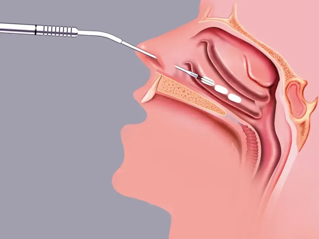 Grafische Darstellung der Einstichstellen für die Applikation der Radiofrequenzenergie in der unteren Nasenmuschel.