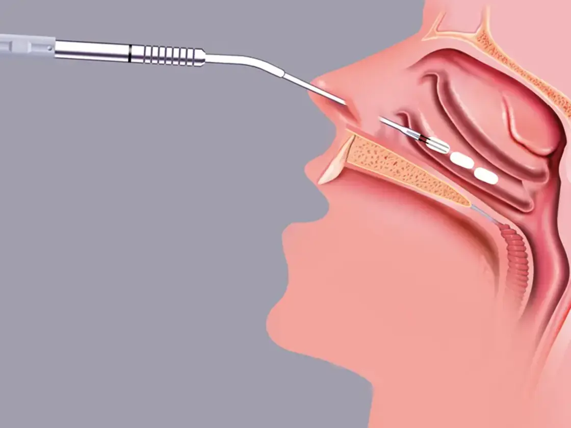 Grafische Darstellung der Einstichstellen für die Applikation der Radiofrequenzenergie in der unteren Nasenmuschel.