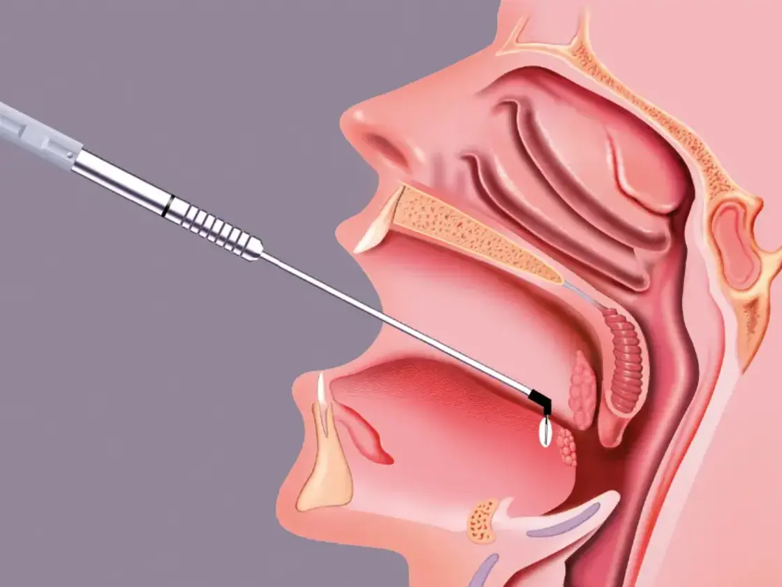 Grafische Darstellung des Einführens der RaVoR™ bipolaren Elektrode am Zungengrund