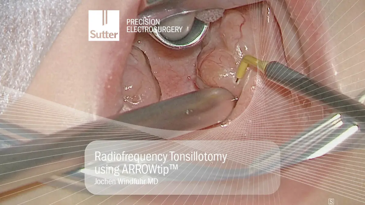radiofrequency-tonsillotomy-arrowtip-jochen-windfuhr.jpg Radiofrequency tonsillotomy procedure using ARROWtip™ performed by Jochen Windfuhr, MD