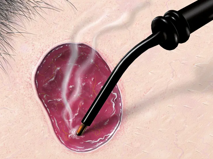 Grafische Darstellung einer chirurgischen Instrumentenspitze, die auf eine Hautfläche aufgesetzt ist.