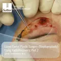 Close-up of upper eyelid plastic surgery (blepharoplasty) using radiofrequency, part 2, performed by Elmar Oestreicher, M.D., showing surgical procedure details.