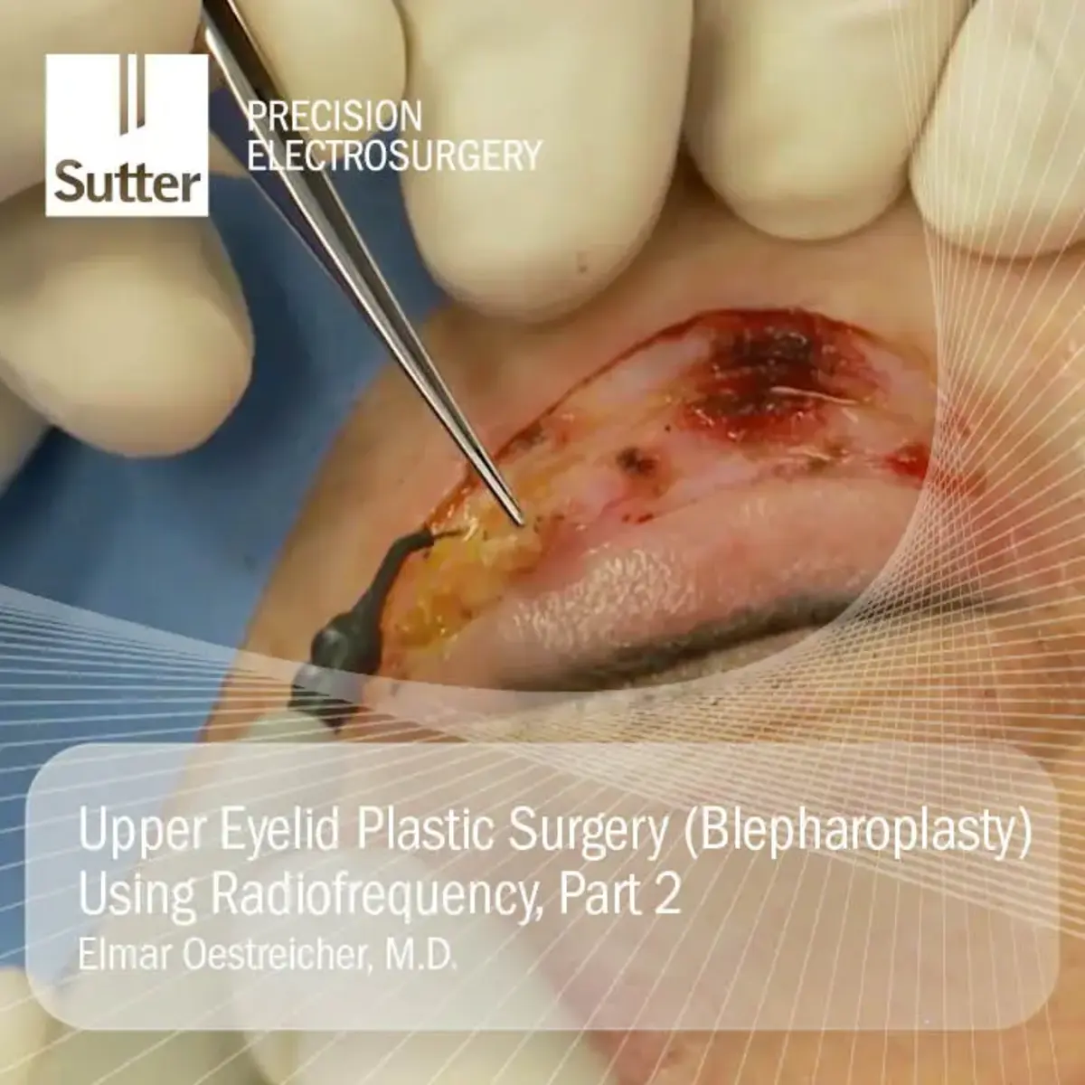 upper-eyelid-plastic-surgery-blepharoplasty-radiofrequency-part2.jpg Close-up of upper eyelid plastic surgery (blepharoplasty) using radiofrequency, part 2, performed by Elmar Oestreicher, M.D., showing surgical procedure details.